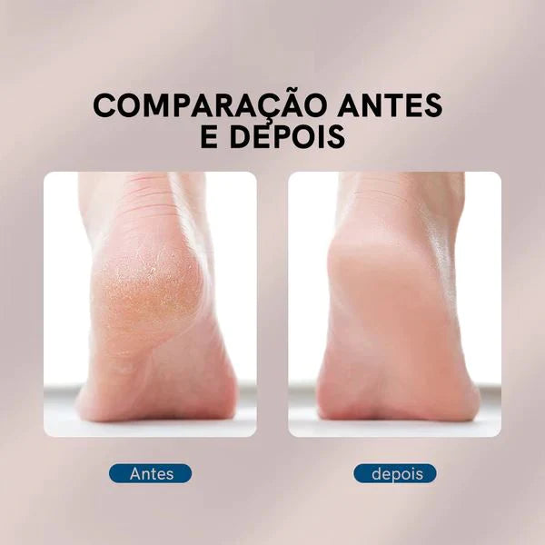 Lixa Elétrica para os Pés Calos Care - Loja Marviva